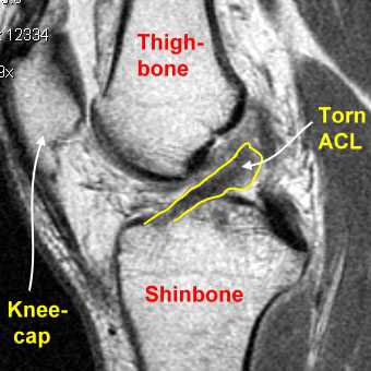 knee mri tear knee mri tear