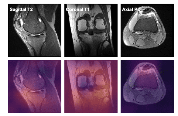 knee mri planes knee mri planes