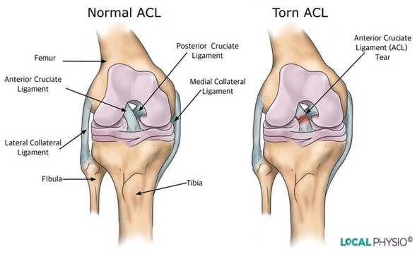 acl tear acl tear